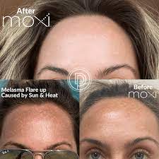 Christmas In July Moxi Face - Single session $500 (reg. $600)