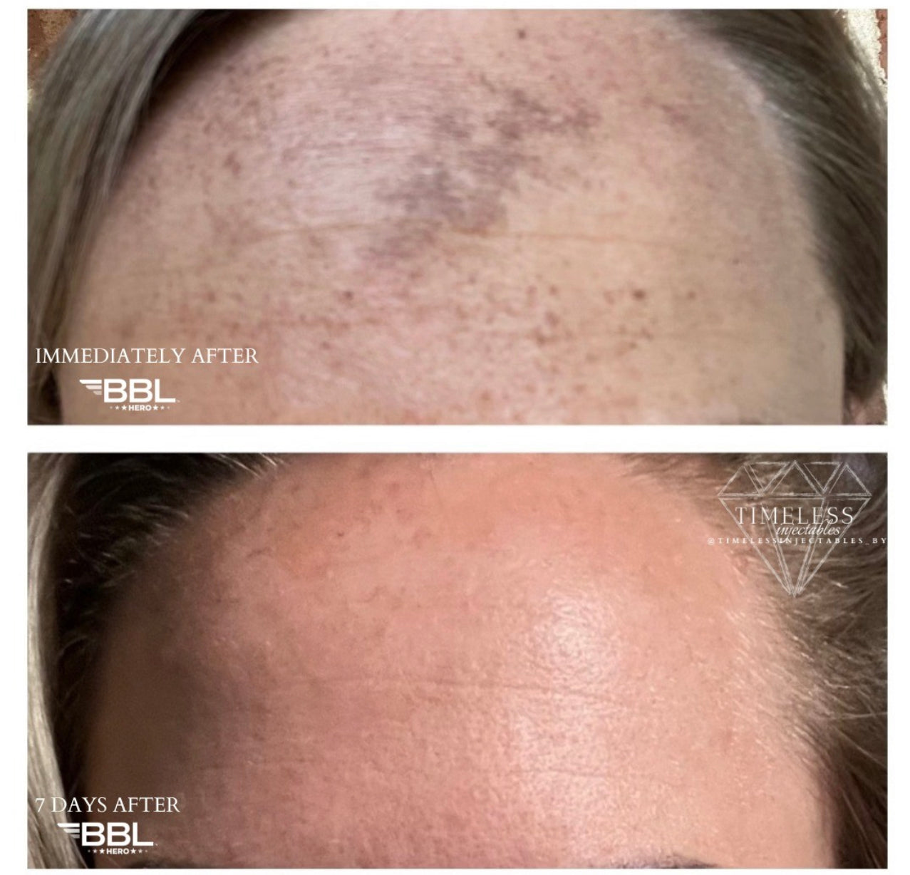 Christmas In July BBL Forever Young Face - Single Session $400 (reg. $500)