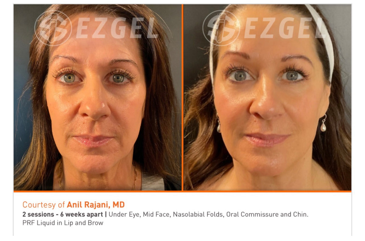 Event - PRF EZ Gel Single Area of Face Rejuvenation