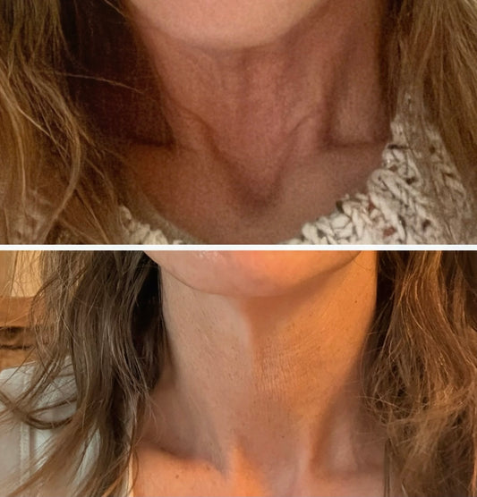 Christmas in July Sale - NeoGen PSR Gel Neck - Single Session