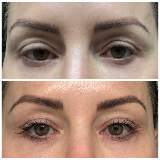 Christmas in July Sale - NeoGen PSR Gel Eyes - Single Session