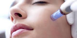 Christmas in July Sale - Microneedling Package of 3 sessions - Face