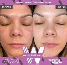 Christmas in July Sale - BBL/MOXI Face Package of 3