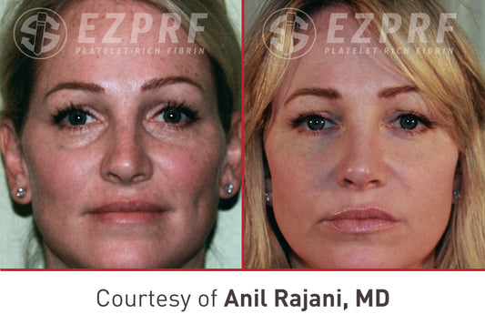 Christmas in July Sale - PRF EZ GEL undereye treatment single session $600 ( Reg. $700)