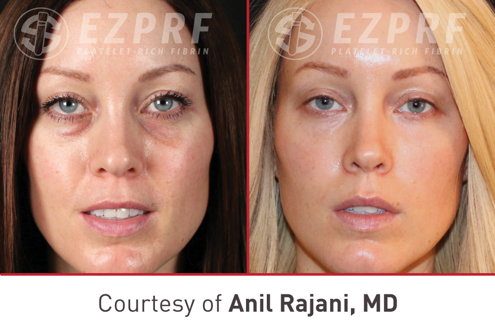 Christmas in July Sale - PRF EZ GEL Full face rejuvenation single session $800 ( Reg. $1200)