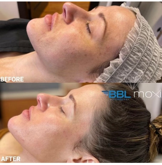 Mother's Day Special - BBL/Moxi Combo Treatment Single Session - Face